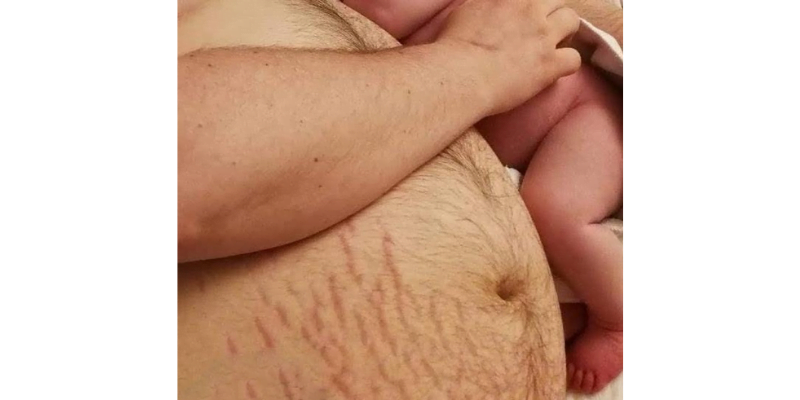Image description: Hairy postnatal abdomen of a white-skinned person, with pink baby legs curled up alongside